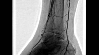 Balloon angioplasty of the popliteal artery [upl. by Calen390]