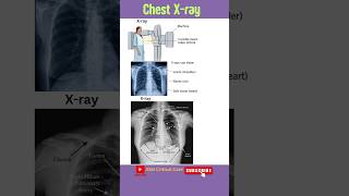 Chest Xray  Xray Machine  Chest Xray Findings  Xray of Chest  PA viewcxr chestxray Xray [upl. by Shoemaker]