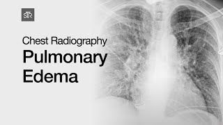 Chest Radiography Pulmonary Edema [upl. by Arnuad]