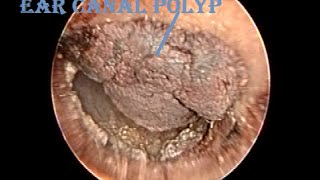 Dried Hemorrhagic Ear Canal Polyp Removal amp Cleaning [upl. by Ahseya848]