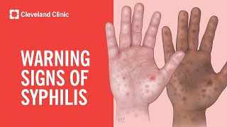 Warning Signs of Syphilis [upl. by Suiradal]