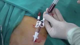 Permanent HD Cath insertion [upl. by Chrissy]