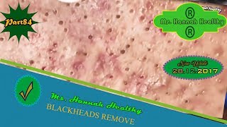 AMAZING NEW UPDATE BETTER REMOVE BLACKHEADS AND REMOVAL BLACKHEADS ON FACE PART 85 [upl. by Alisan]