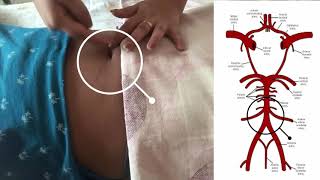 AORTIC COMPRESSION Postpartum Hemorrhage [upl. by Sissie]