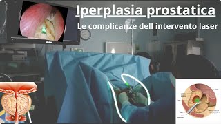 Prostata ingrossata Le complicanze dell intervento chirurgico [upl. by Ydoc]