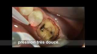 PHILIPS LASER Eviction gingivale technique 2wmv [upl. by Eliam]