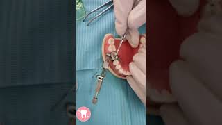 طريقة عمل حشوة أملغم كلاس ٢ \ class 2 amalgam restoration [upl. by Obaza]