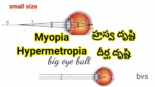 Myopia Hypermetropia corrections [upl. by Aicnatsnoc680]