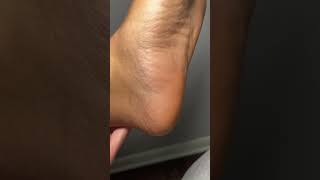 Best Way to Get Did of Calluses  TikTok Viral Foot Peel Mask footpeeling shorts feet peeling [upl. by Akemyt]