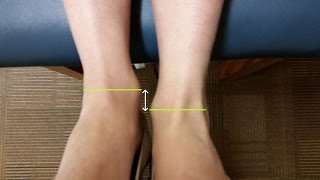 Leg Length Discrepancy  RunSmartOnlinecom [upl. by Arhoz]