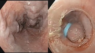 Endoscopic Variceal Ligation EVL  GI Bleeding  SQUARE HOSPITAL LTD Dhaka Bangladesh BDENDOSCOPY [upl. by Coulter889]