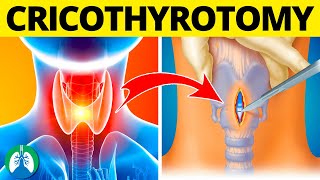 Cricothyrotomy Medical Definition  Quick Explainer Video [upl. by Ume642]