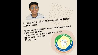 Case of a 13 year old boy treated with Orthodontics ie growth modification amp fixed metal braces [upl. by Yznel779]