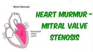 Mitral Stenosis  Auscultation Sound [upl. by Aiynot]