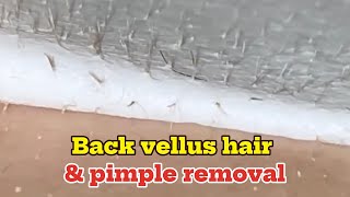 Back vellus hair amp pimple removal [upl. by Adnolor]