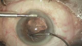 Robotic Cataract Surgery SEH5036 [upl. by Rainger]