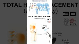 Total Hip Replacement  animation 3d short  learn Biology with Aliya [upl. by De Witt]