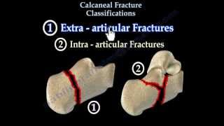 Calcaneal Fracture Classifications  Everything You Need To Know  Dr Nabil Ebraheim [upl. by Nallac]