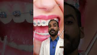 🤷‍♂️Teeth Gap Treatment dentist dentalclinic teethgapmakeover [upl. by Geis]