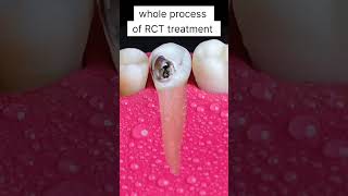 Whole process of Root Canal rootcanals localdentistry asmr youtubeshorts dental [upl. by Sairtemed]