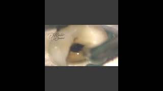 Separated instrument removal root canal treatment [upl. by Anitaf]