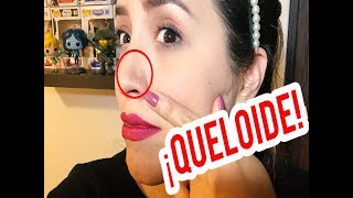 ¿Qué pasó con la perforación de mi nariz ¿Cómo curar un queloide Storytime [upl. by Simons684]