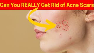 Can You REALLY Get Rid of Acne Scars in 2 Ways [upl. by Atteroc]