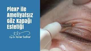 Plexr ile Ameliyatsız Göz Kapağı Estetiği Plexr Soft Surgery OpDrTaner Bahar [upl. by Aehsa]