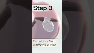 Allurion Gastric Balloon  A Simple Solution to Lasting Weight Loss [upl. by Chickie]