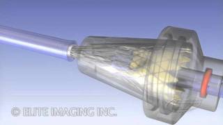 Loading Heart Valve Catheter  Medical amp Scientific Video Production [upl. by Annaik]