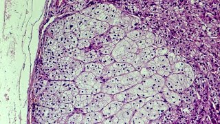 What is Hyperplasia  Pathology mini tutorial [upl. by Hsemar]