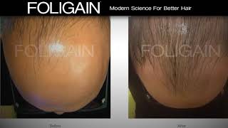 FOLIGAIN High Performance Hair Solutions [upl. by Gunn]