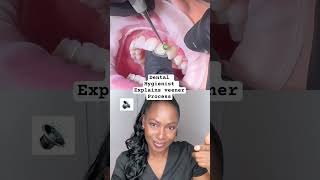 Dental hygienist reacts shorts reaction veneers [upl. by Assennav41]