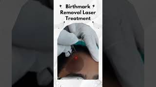 BIRTHMARK REMOVAL LASER TREATMENT birthmark birthmarks birthmarksarebeautiful skincare [upl. by Roper]