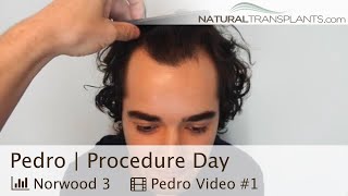 Defeating a Receding Hairline Hair Transplant at 23 for Norwood 3 Hair Loss  Dr Huebner Pedro [upl. by Surtimed852]