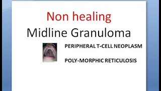 ENT Non healing Midline Granuloma compare Wegener Granulomatosis Diagnosis Treatment EBV [upl. by Pia902]