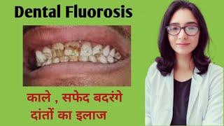 Dental fluorosis causes treatmentflouride के पानी से दांत खराब होने का इलाजबदरंगे दांतो का इलाज [upl. by Amoeji]