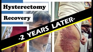 Hysterectomy 2 Years Later Estradiol Hormone Patch Review [upl. by Eahcim652]