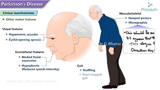 Parkinsons Disease🧠  Etiology  Pathophysiology  Clinical manifestations  Diagnosis  Treatment [upl. by Persian]