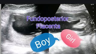 Fundoposterior placenta  Anterior placenta means baby boy  Posterior placenta means baby girl [upl. by Laekim]