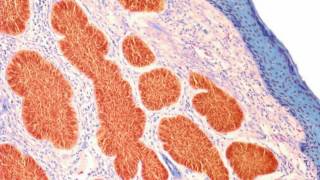 Difference Between Carcinoma and Sarcoma [upl. by Purvis]