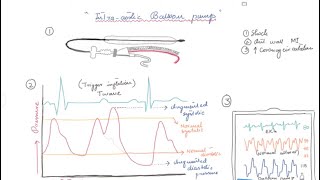 Intra Aortic Balloon Pump IABP and IABPSHOCK II trial [upl. by Reinald368]