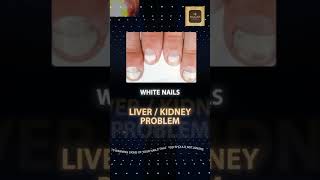 NAIL HEALTH ALERT healthalert nail YouTube [upl. by Aisila]