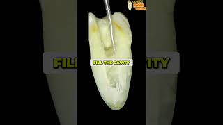 Restorative Dentistry Achieving Perfect Cavity Fillings [upl. by Berkley404]