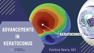 Advancements in technology to treat Keratoconus [upl. by Helbonna956]