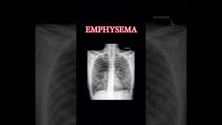 X ray findings for emphysema… medicineviva viva medicine practical exam mbbs medicalstudent [upl. by Burg]