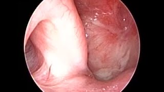 Nasopharyngeal Carcinoma SCC 10 years Follow up after Radiotherapy amp Chemotherapy [upl. by Fraya]