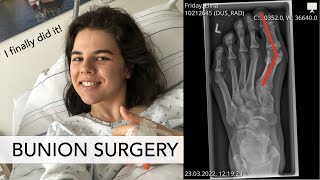 BUNION SURGERY I Would I do it again Lets talk about pain scars recovery [upl. by Eilema]