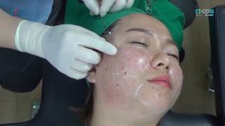 Non surgical Full Facelift PDO thread technique  NCog amp NScaffold [upl. by Laeria]