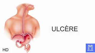 Ulcère causes signes et symptômes diagnostic et traitement [upl. by Anwahsit]